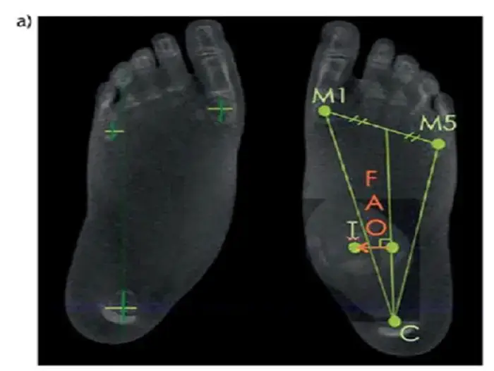 A foot x-ray showing...