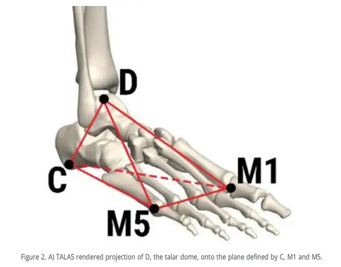 A diagram of the foot showing the Talas and talar dome